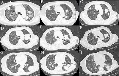 Case report: Simultaneous occurrence of primary pulmonary lymphoma and opportunistic infections in a patient with chronic myeloid leukemia